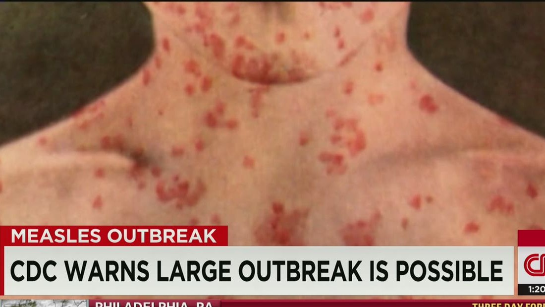 Another Measles Case In Virginia: Public Health Concerns For 2025 Another Measles Case In Virginia: Public Health Concerns For 2025