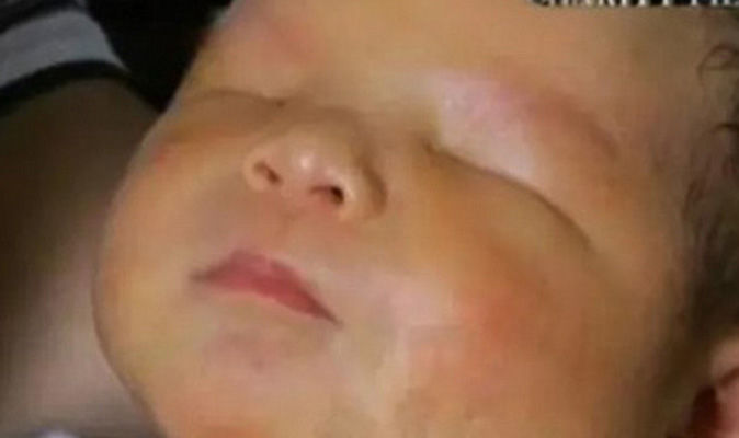 Baby Born Without Eyes: Living With Bilateral Anophthalmia Baby Born Without Eyes: Living With Bilateral Anophthalmia