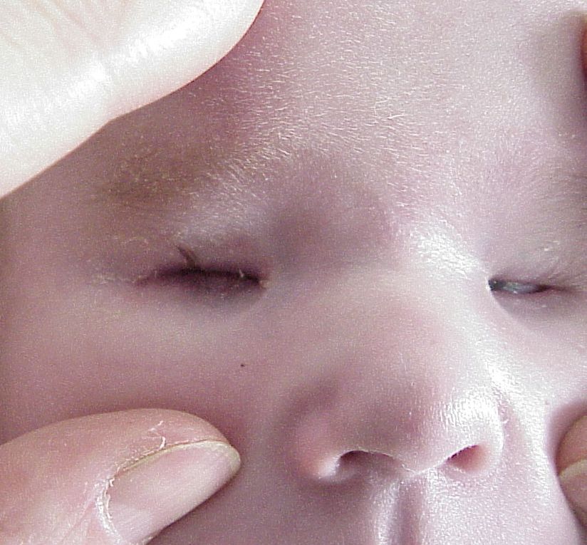 Bilateral Anophthalmia: Challenges And Hope For Families Bilateral Anophthalmia: Challenges And Hope For Families
