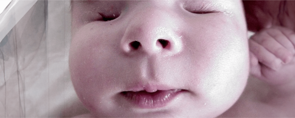 Bilateral Anophthalmia: Understanding The Rare Condition Of Being Born Without Eyes Bilateral Anophthalmia: Understanding The Rare Condition Of Being Born Without Eyes