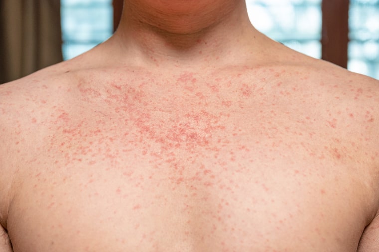 Falling Short: Canada's Measles Elimination Status Under Threat Falling Short: Canada's Measles Elimination Status Under Threat