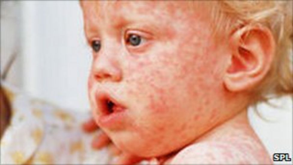 Measles In Kansas: Tracking The Recent Increase And Its Implications Measles In Kansas: Tracking The Recent Increase And Its Implications