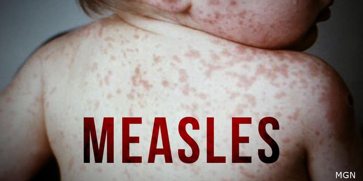 Measles Outbreak In Kansas: A Growing Concern Measles Outbreak In Kansas: A Growing Concern