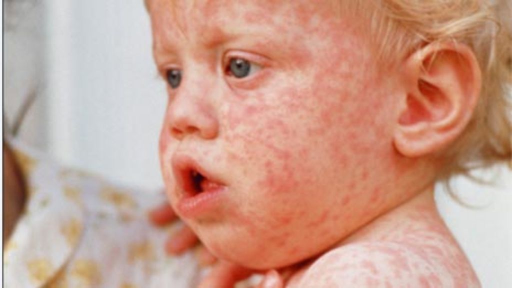 Measles Outbreak Prompts School Quarantine In North Dakota: Impact On Unvaccinated Children Measles Outbreak Prompts School Quarantine In North Dakota: Impact On Unvaccinated Children