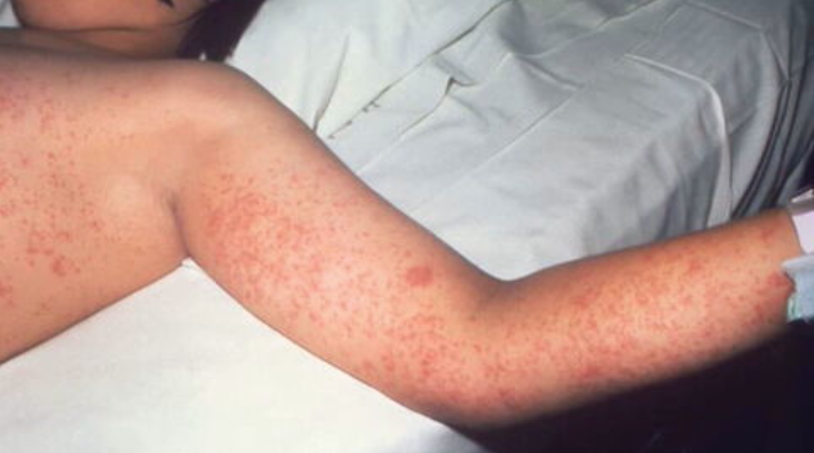 Measles Outbreak Update: Second Case Reported In Virginia In 2025 Measles Outbreak Update: Second Case Reported In Virginia In 2025