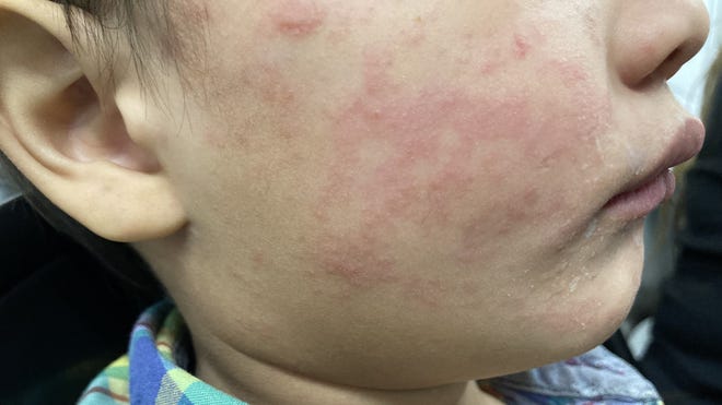 Texas Measles Outbreak: Independent Cases On The Rise Texas Measles Outbreak: Independent Cases On The Rise