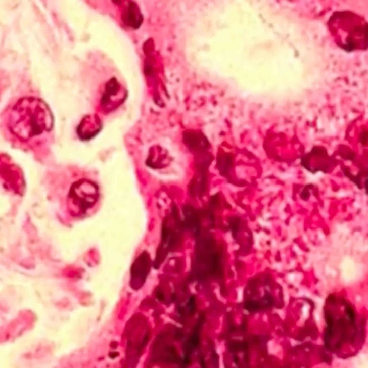 Texas Sees Rise In Measles Cases Independent Of Main Outbreak Texas Sees Rise In Measles Cases Independent Of Main Outbreak