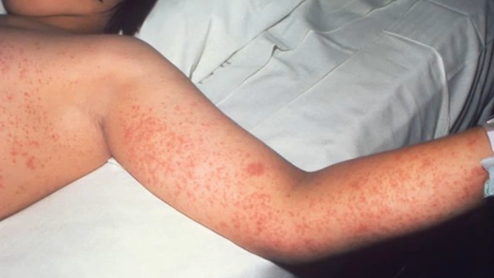 Uptick In Unrelated Measles Cases Reported Across Texas Uptick In Unrelated Measles Cases Reported Across Texas