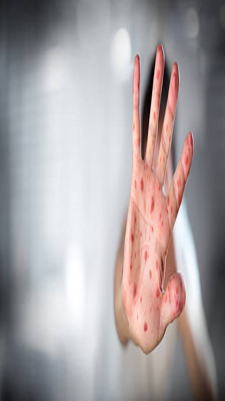 US Measles Outbreak Update: Case Count At 1,046 US Measles Outbreak Update: Case Count At 1,046